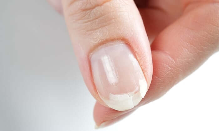 เล็บฉีก 