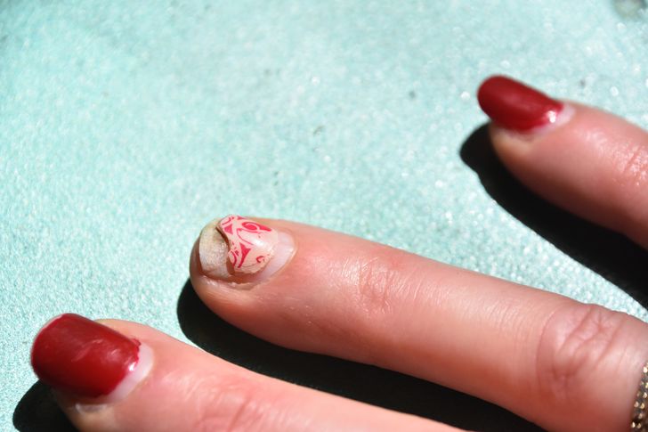 เล็บมือหัก 